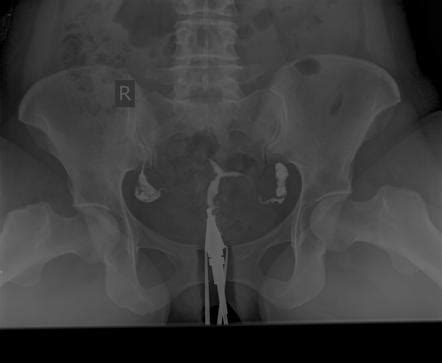 Blocked fallopian tube - hydrosalpinx | Radiology Case | Radiopaedia.org