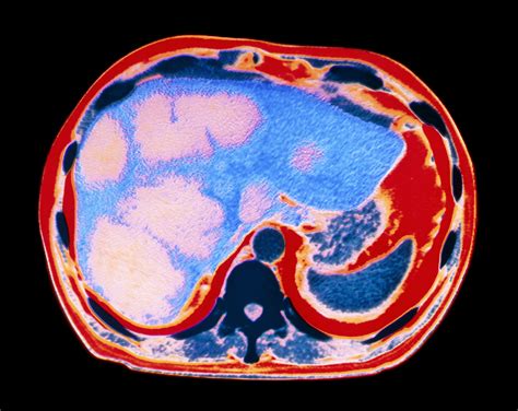 Liver Cancer: Overview and More