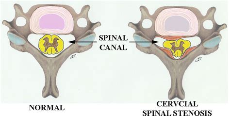 Cervical Spinal Stenosis