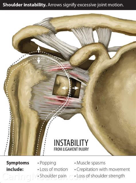 Dislocated Shoulder Rehab Exercises | EOUA Blog