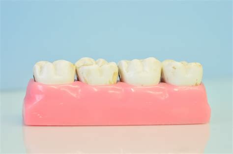 Tooth Discoloration: Types, Causes, Prevention and Treatment - My Dentist Burbank