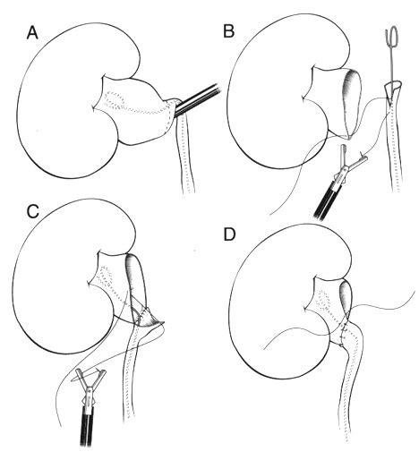 Laparoscopic Pyeloplasty | Johns Hopkins Medicine