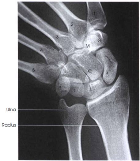 SCAPHOID X-RAY | ULNAR DEVIATION - RadTechOnDuty