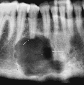 Central giant cell granuloma of the jaw: a review of the literature with emphasis on therapy ...