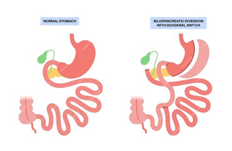 Premium Vector | Biliopancreatic diversion with duodenal switch bpd stomach surgery weight loss ...