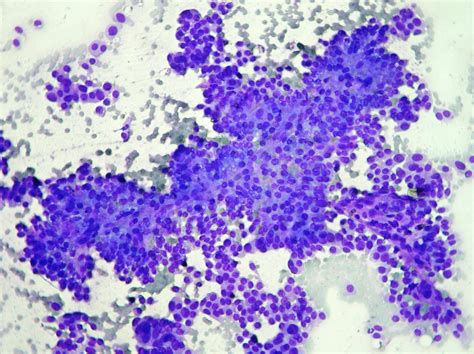 Breast Cytopathology – Cellnetpathology.com