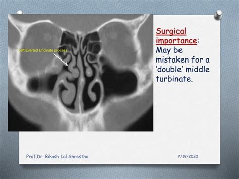 All about uncinate process of nose and paranasal sinuses