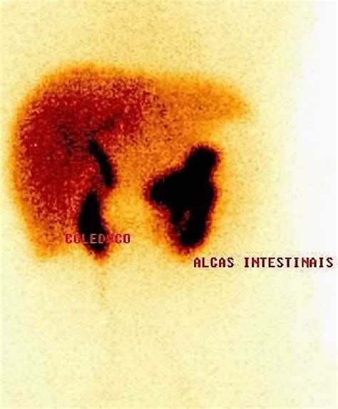 Cholescintigraphy in acute calculous cholecystitis. | Download ...