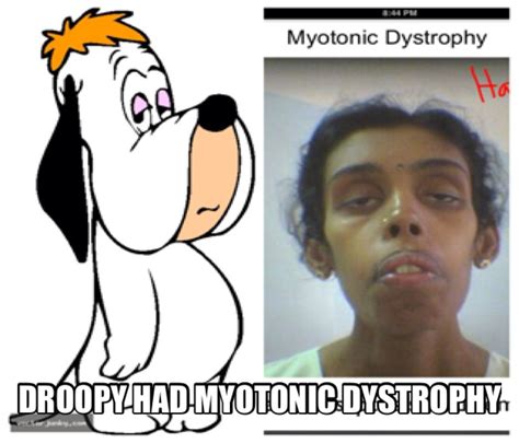 Myotonic Dystrophy | Myotonic dystrophy, Nursing notes, Pediatric nursing