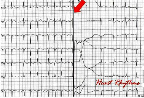 ECG Rhythms: AF cardioversion