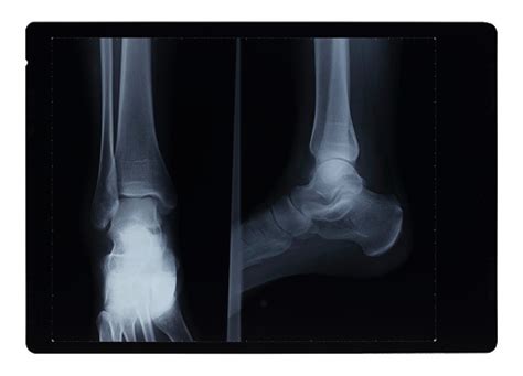 Ankle Xray Hairline Fracture Stock Photo - Download Image Now - X-ray Image, Black Color, Bone ...