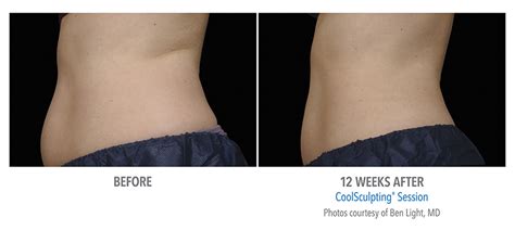 Coolsculpting Near Me | Coolsculpting | Coolsculpting before and after