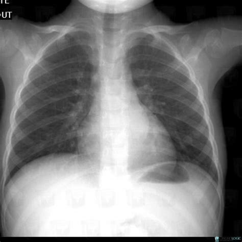 Radiology case : Ganglioneuroma (X rays ,MRI) - Diagnologic