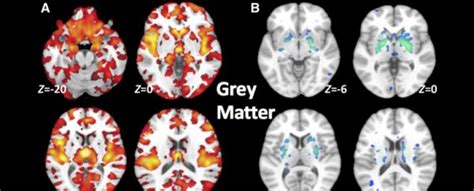 Brain Scans Reveal a New Schizophrenia Type That Almost Looks Like a ...