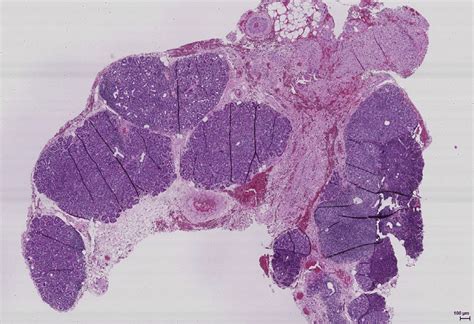 e Biopsy of a lacrimal gland with focal infiltrations of mononuclear... | Download Scientific ...