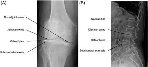 Subchondral Bone Cyst: Causes, Treatment, And More, 40% OFF