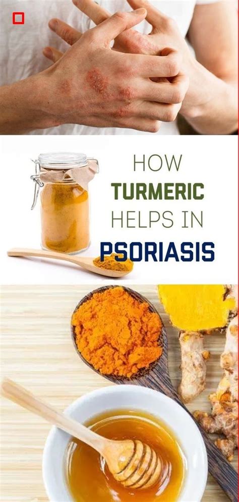 HONEY AND TURMERIC: THE ONLY EFFECTIVE MIXTURE THAT HEALS PSORIASIS AT A FASTER RATE | Natural ...