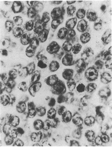 Lymphoma of pre-B lymphoblasts (lymphoblastic lymphoma , pre-B type ...