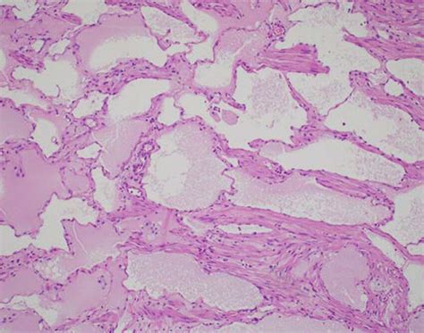 Lymphatic malformation at high power (H&E). The image demonstrates ...