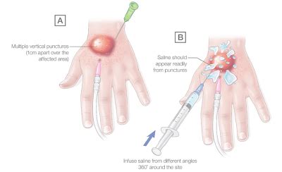 Iv Infiltration Signs