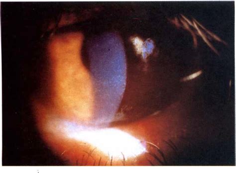 Severe superficial punctate keratitis and punctate epi­ thelial ...