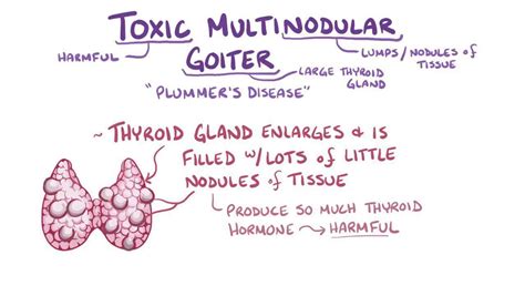 Toxic multinodular goiter: Video, Anatomy & Definition | Osmosis