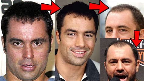 Joe Rogan Hair Transplant Failure! Here's what went wrong!