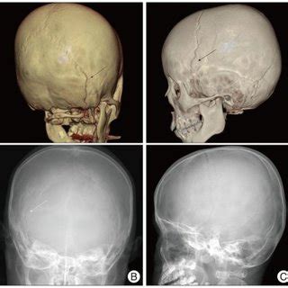 Depressed skull fracture in the simple X-ray and 3 dimensional computed... | Download Scientific ...