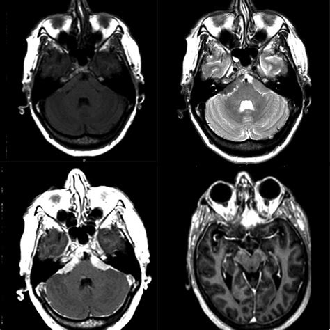 MRI sequences demonstrating typical appearance of extensive skull base... | Download Scientific ...