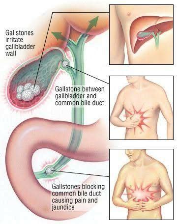 Cholelithiasis cholecystitis symptoms causes complications and ...