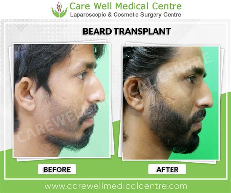 Treatments Before & After Results Gallery | Care Well Medical Centre