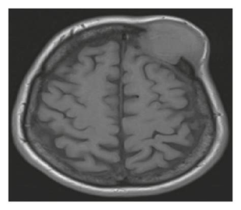 MRI brain showing calvarial mass lesion extending intracranially ...