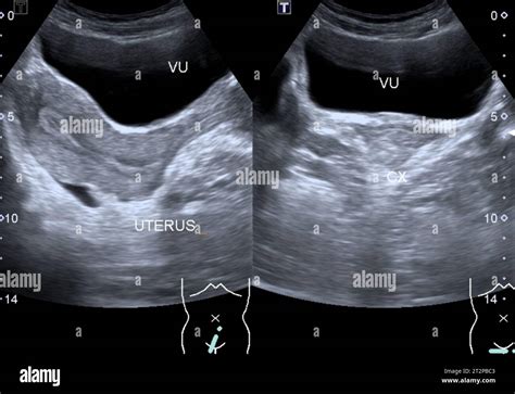 Healthy uterus, ultrasound scan Stock Photo - Alamy