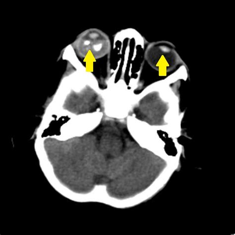 Retinoblastoma CT scan - wikidoc