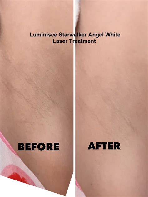 Whiter and brighter underarm instantly with Luminisce Starwalker Angel White Laser! - Rochelle ...