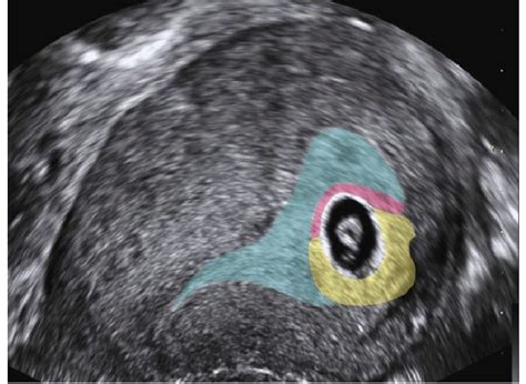 Ultrasound Image Showing the Position of the Three Regions of Decidua ...