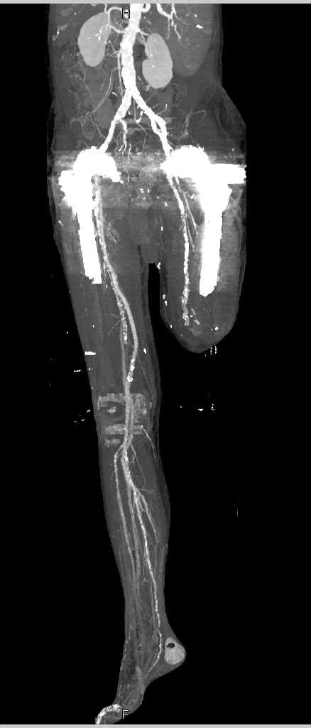 Femoral-Politeal Bypass Grafts - Vascular Case Studies - CTisus CT Scanning