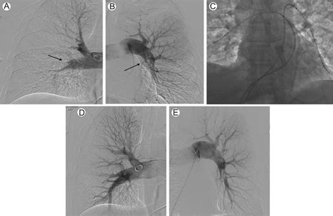 Catheter-Directed Thrombolysis for Pulmonary Embolism: The State of ...