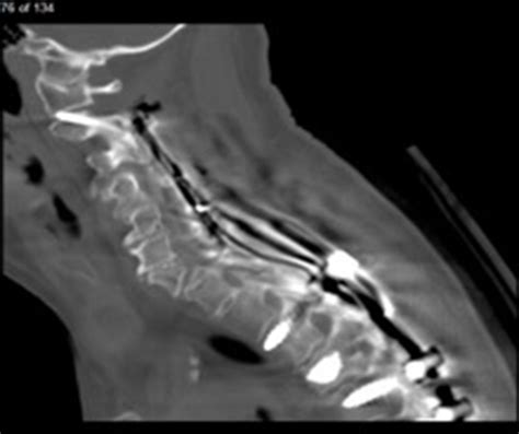 C1-C2 Facet Joint Penetration by C2 Pedicle Screws: Influence of Local ...