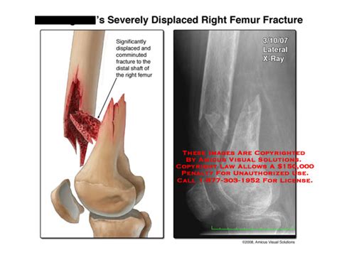 Severely Displaced Right Femur Fracture