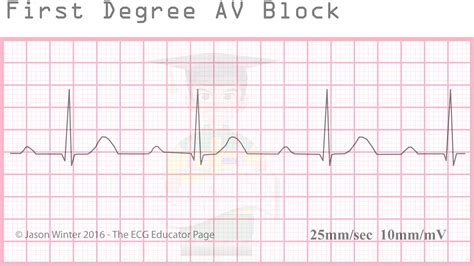 ECG Educator Blog : Heart Blocks