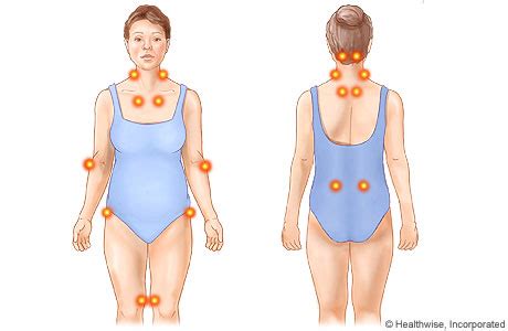 Fibromyalgia Tender Points | Cigna