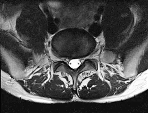 Compression of the S1 Nerve Root by an Extradural Vascular Malformation: A Case Report and ...