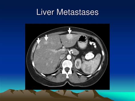 PPT - Liver Metastases PowerPoint Presentation, free download - ID:438008