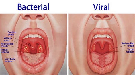 Strep Throat Red Spot On Tonsil - Jameslemingthon Blog