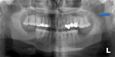 Fractured zygomatic arch: a traumatic cause for trismus | BMJ Case Reports