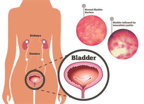 How to manage Interstitial Cystitis/Bladder Pain Syndrome?
