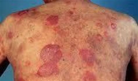 Mycosis Fungoides - Mighty Guide