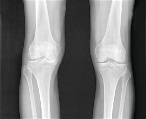 Knee pathologies, including multiple meniscal tears, predict ...