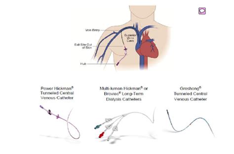 Non Tunneled Central Venous Catheter